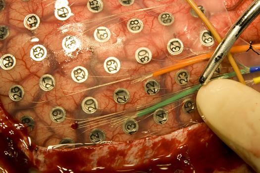 Electrodes being attached to a brain